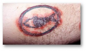 Na een tatoeage kan psoriasis ontstaan of verergeren.