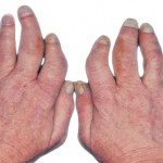 Voorbeeld van arthritis psoriatica