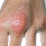 Voorbeeld van arthritis psoriatica